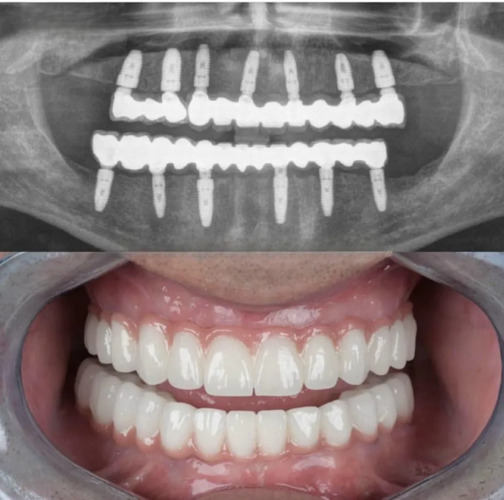 Panoramic X-ray showing implant-supported bridges in both jaws and the completed restoration