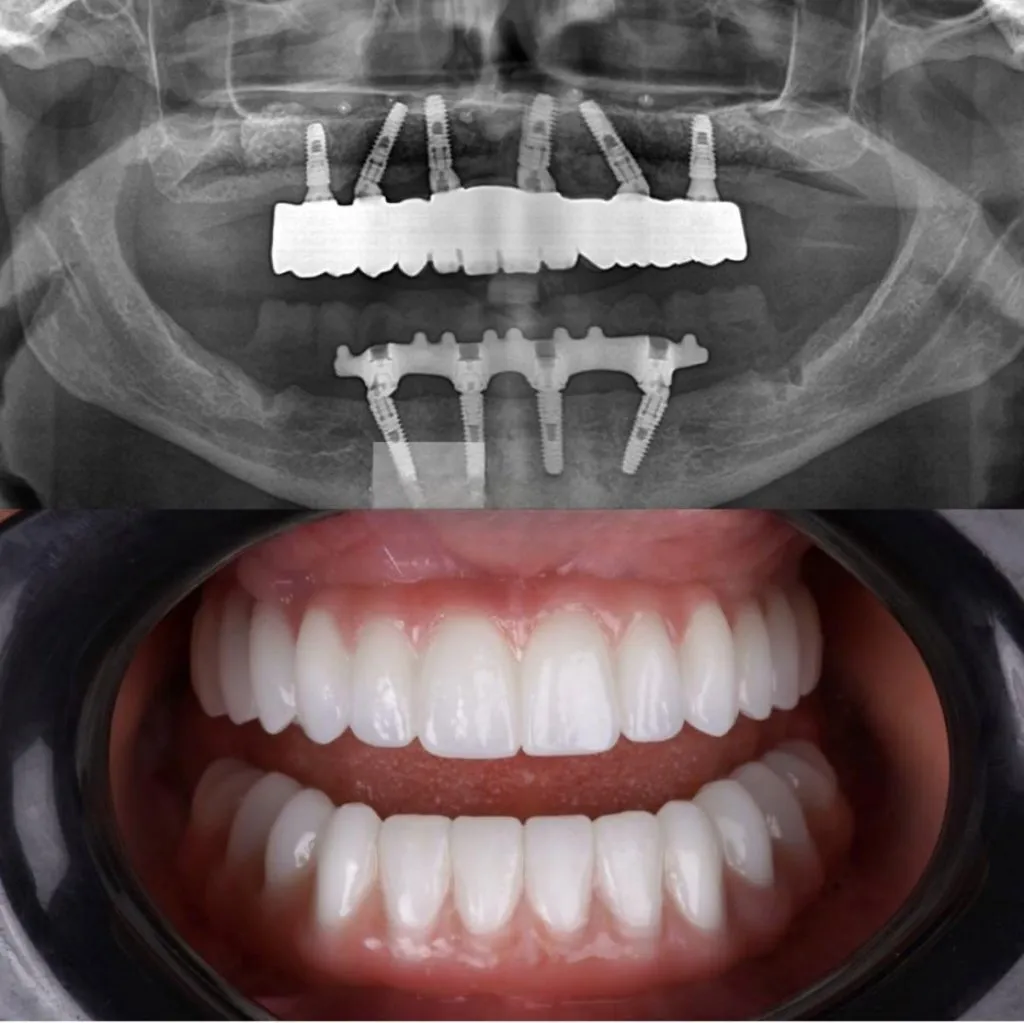 Hollywood Smile: Complete Guide to Treatment, Veneers & Costs in Turkey