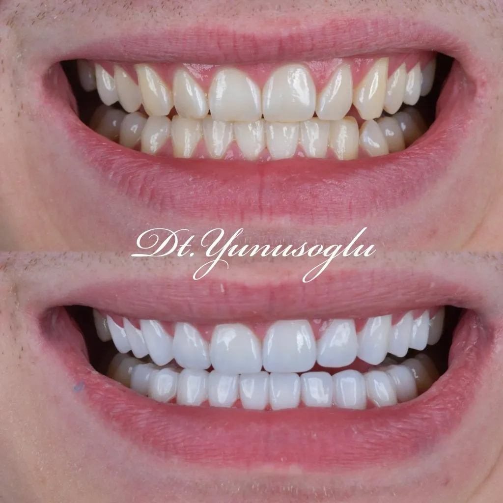 Close-up before and after: yellowed teeth transformed into a brighter, even smile
