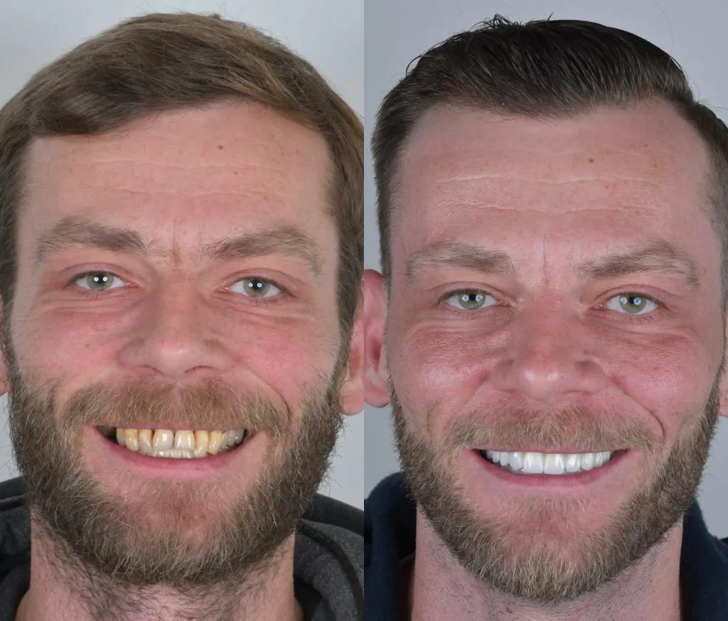 Male patient before and after a full smile makeover: discolored, uneven teeth restored to an even white smile