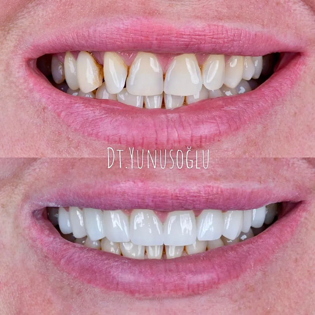 Worn, stained teeth restored - before & after