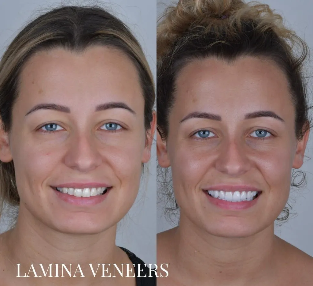 Laminate veneers - before & after