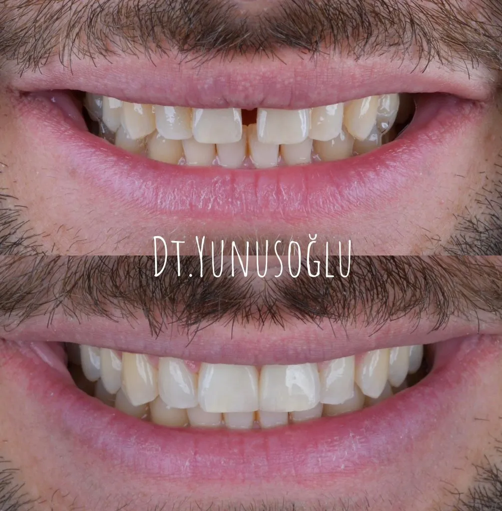 Close-up before and after: gap between the upper front teeth closed and the smile line evened out