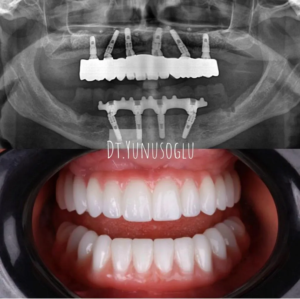 Panoramic X-ray of full-arch dental implants with fixed bridges and the finished smile