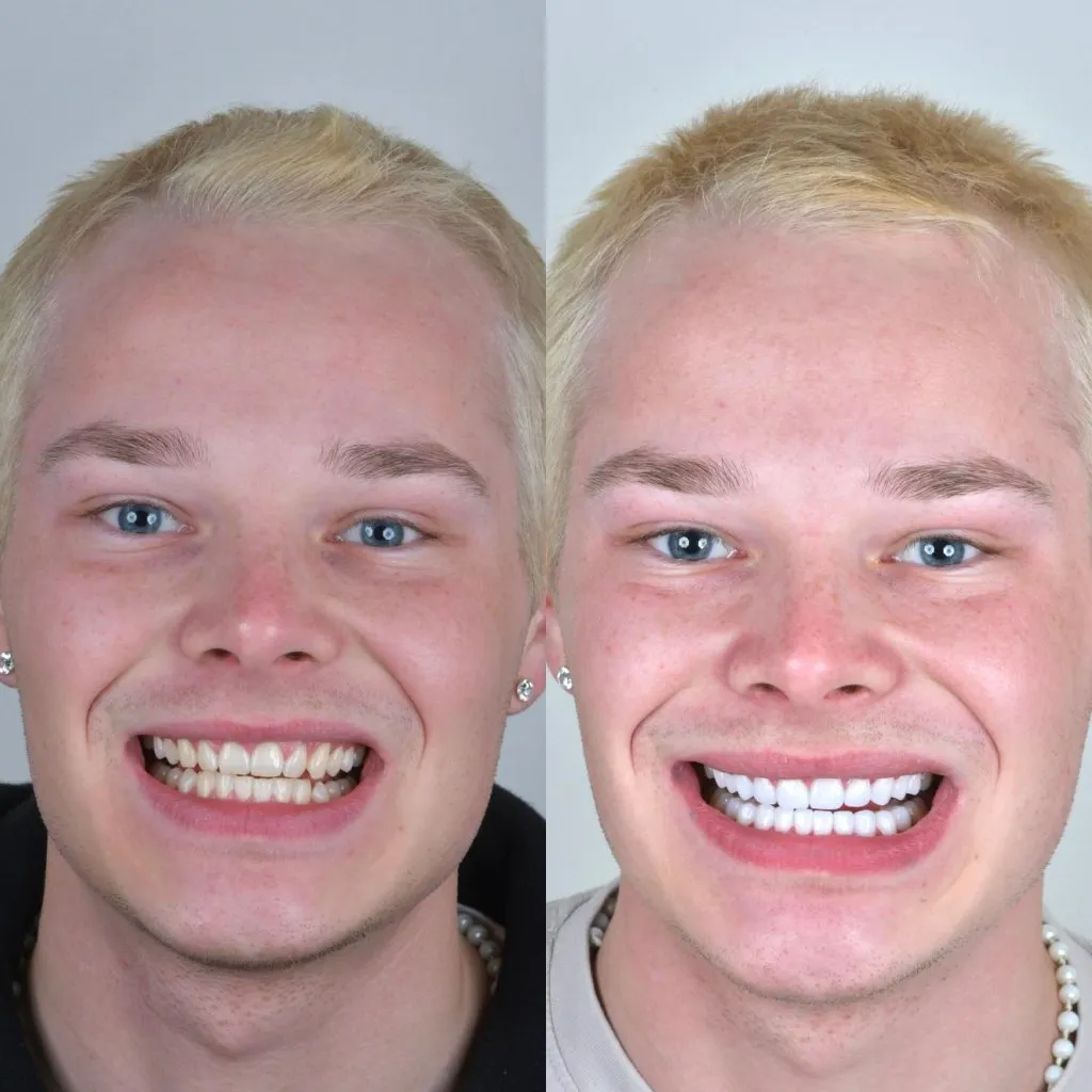 Smile transformation - before & after