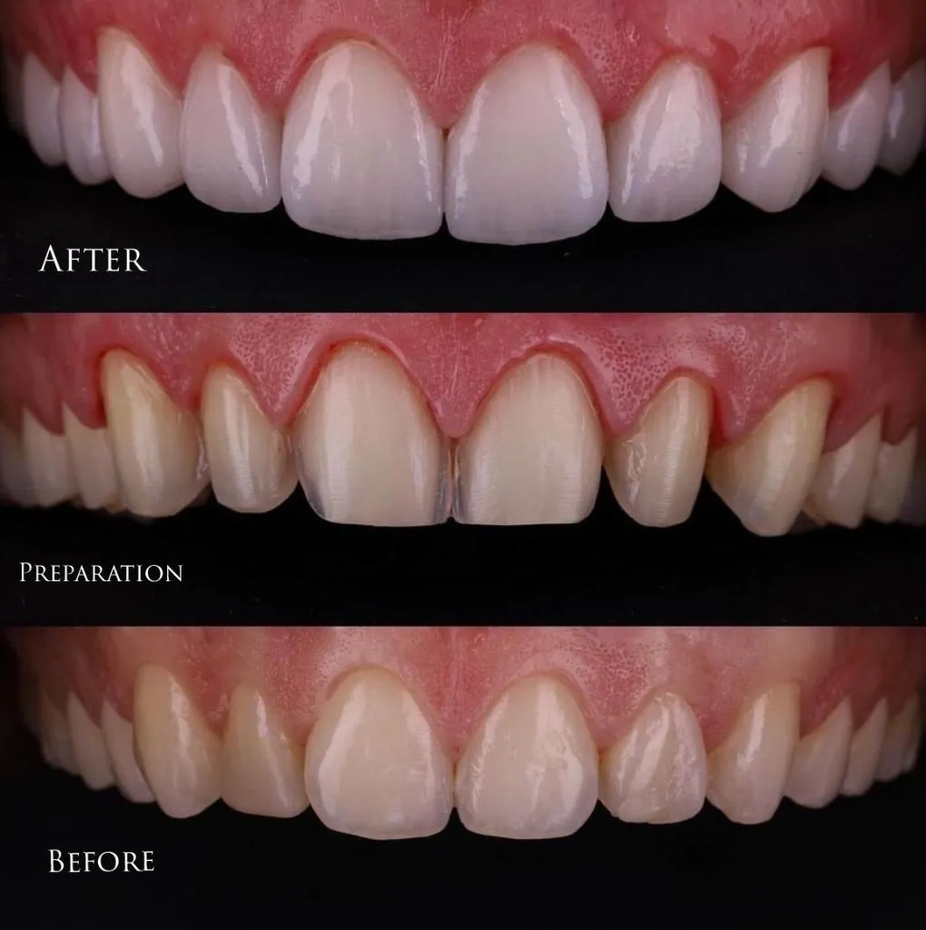 Veneers: before, preparation & final result