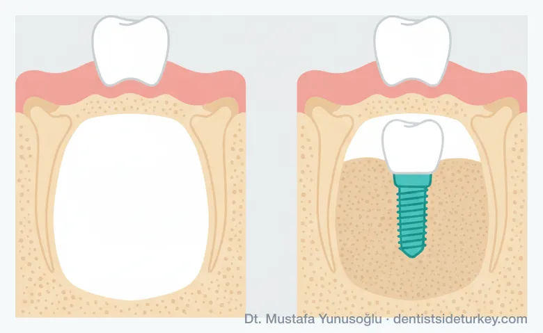 Sinus lift comparison: thin upper jawbone beneath the sinus cavity, and the same jaw after bone grafting with an implant in place