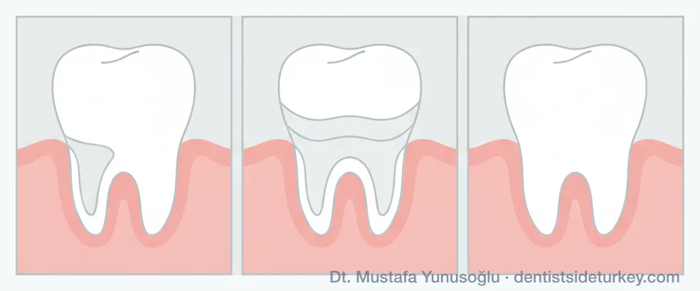 Composite bonding in three stages: a chipped front tooth, composite built up in layers, and the finished restored edge