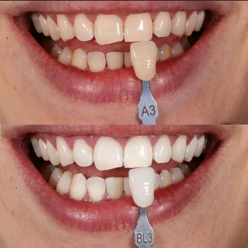 Teeth whitening result measured with a VITA shade guide: shade A3 before, BL3 after