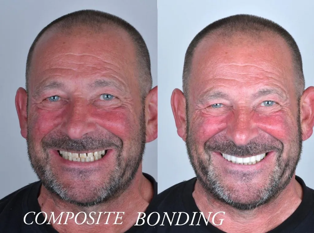Composite bonding - before & after