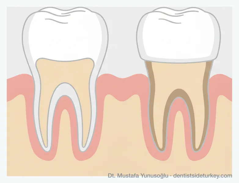 Veneer versus crown comparison: a thin shell bonded to the front of an intact tooth, and a crown capping a tooth ground down on every side