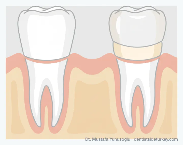 Zirconia crown shown as one solid white layer beside a layered porcelain crown with a translucent outer shell over an inner core